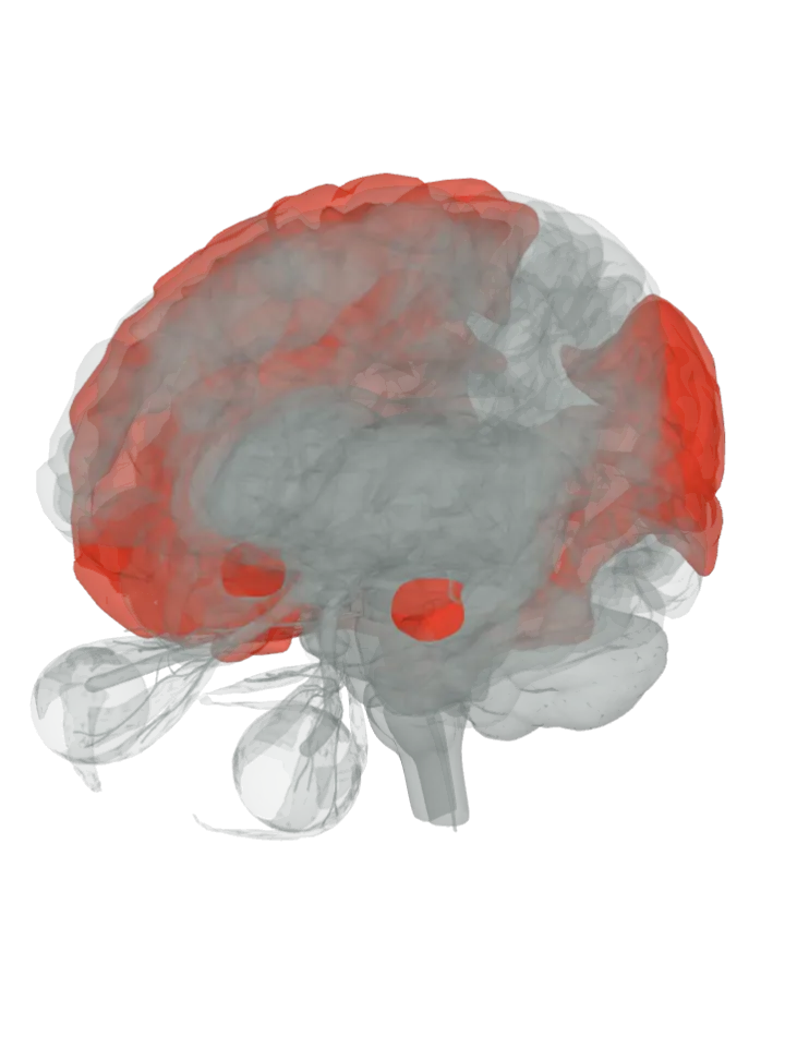 The superior frontal gyrus, the orbitofrontal cortex, the supramarginal gyrus, the angular gyrus, the superior temporal gyrus, the amygdala and the fusiform gyrus lit in red on a 3D model of the brain, seen from the front left and above