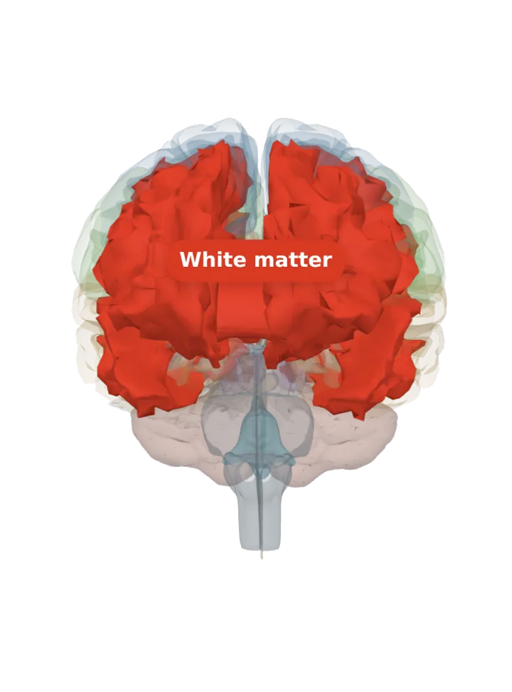 The white matter lit in red on a 3D model of the brain cut by a front (coronal) slice, seen from the front